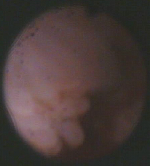 Гиперплазия слизистой оболочки цервикального канала